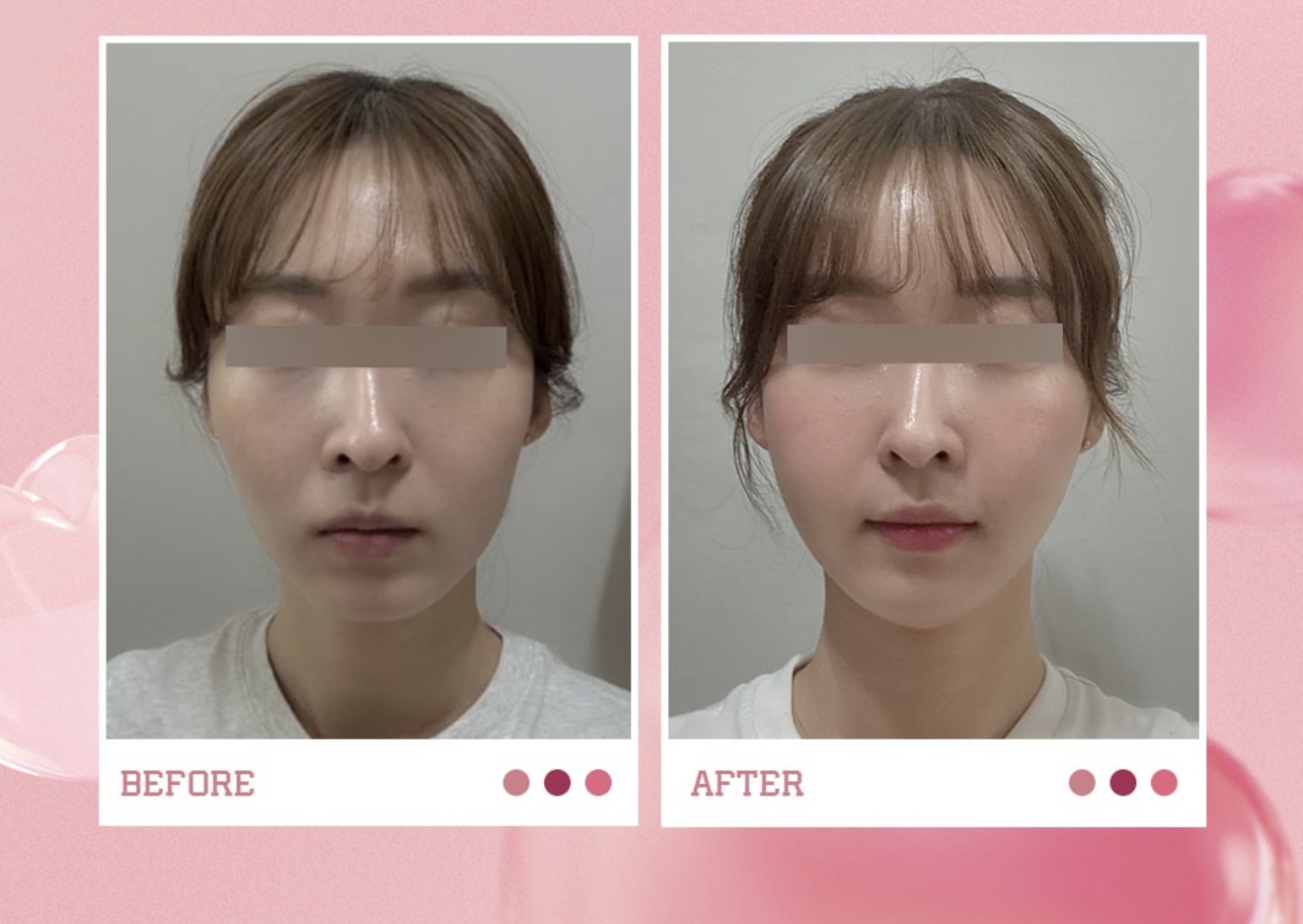 オメガ美容外科さんのビフォーアフター