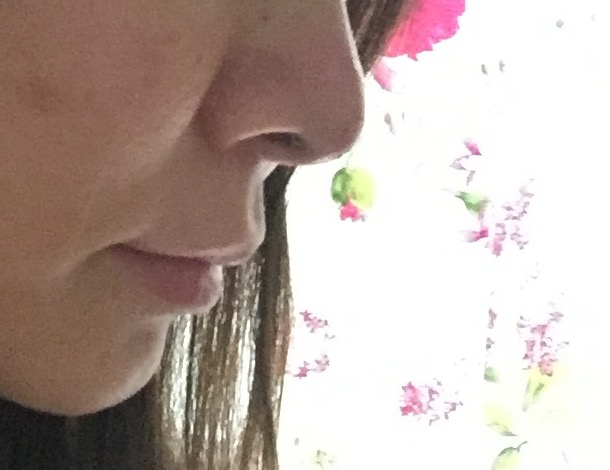 耳介軟骨移植から約1週間後の鼻を横から撮影した写真